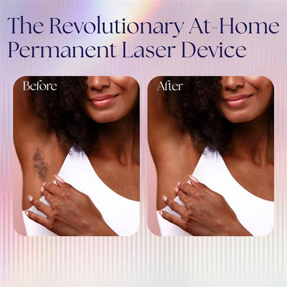 Woman with melanin rick skin before and after Epilaser treatment