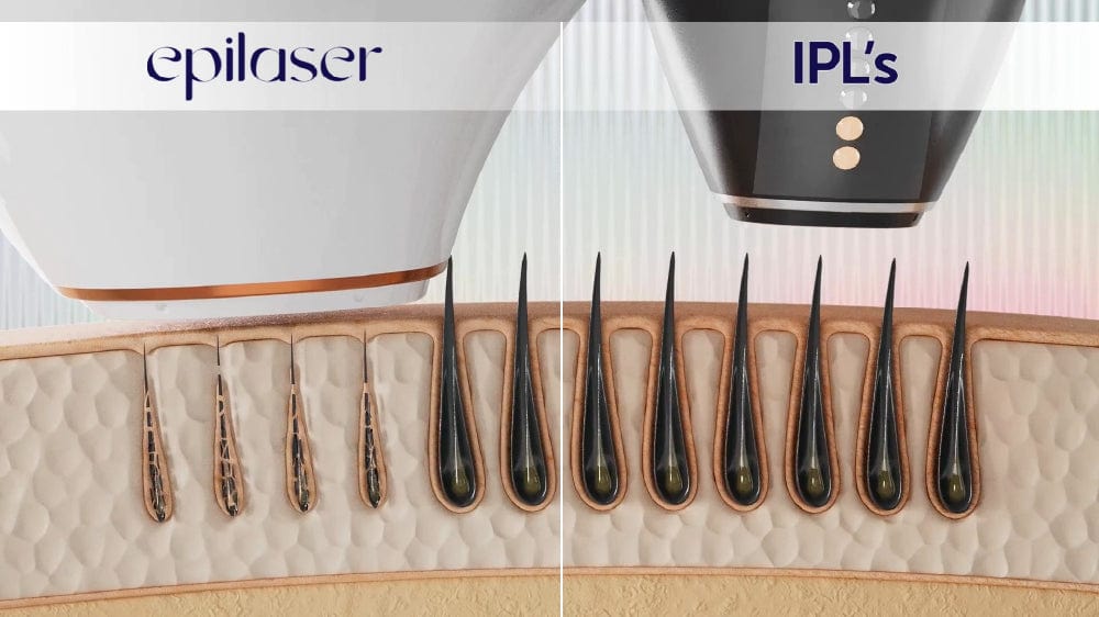 Φόρτωση βίντεο: Βίντεο απολιπαντικού έναντι IPL