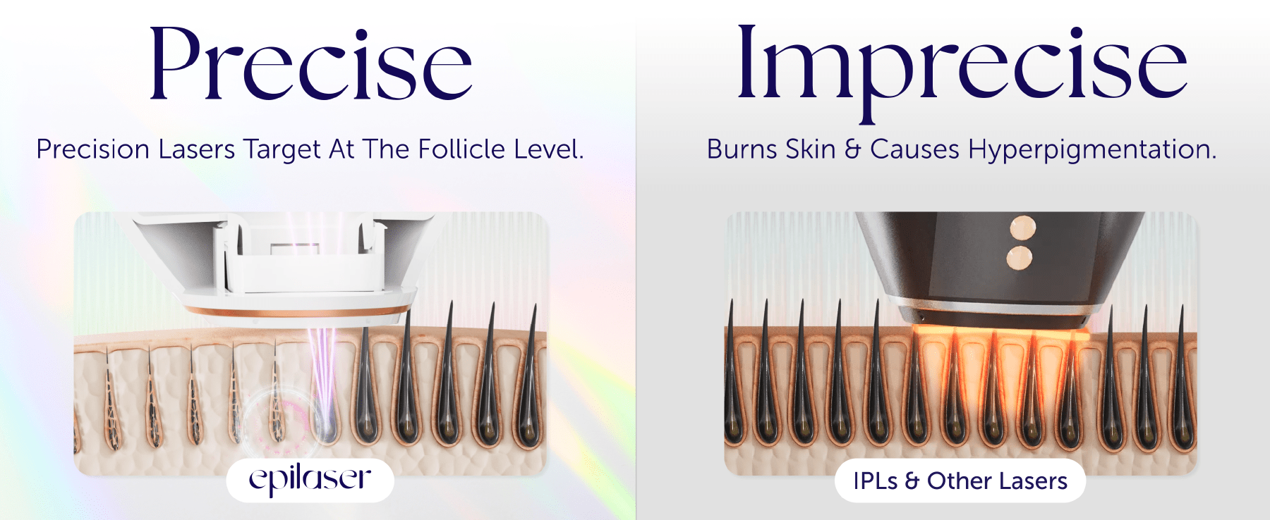 Epilaser precision laser hair removal versus broad IPL