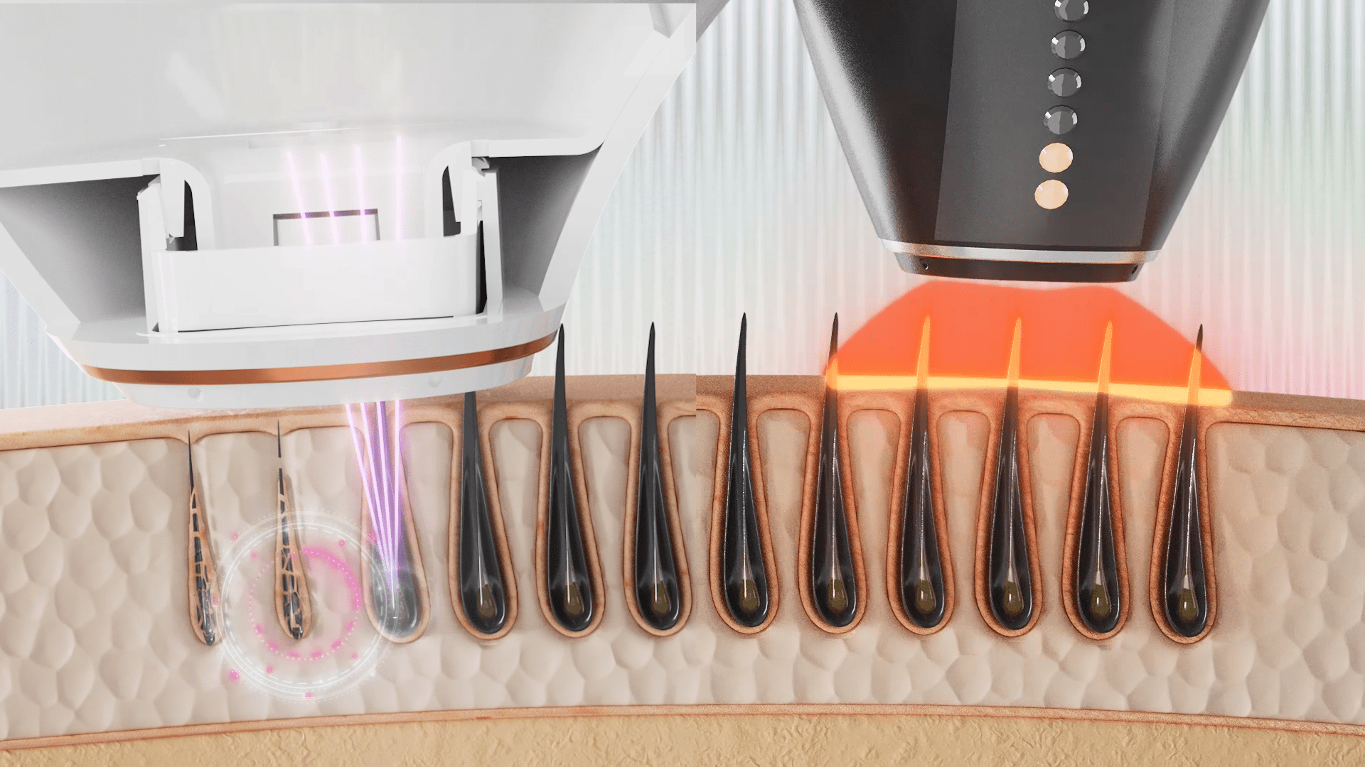 Φόρτωση βίντεο: Πώς να χρησιμοποιήσετε το αποτριχωτικό λέιζερ