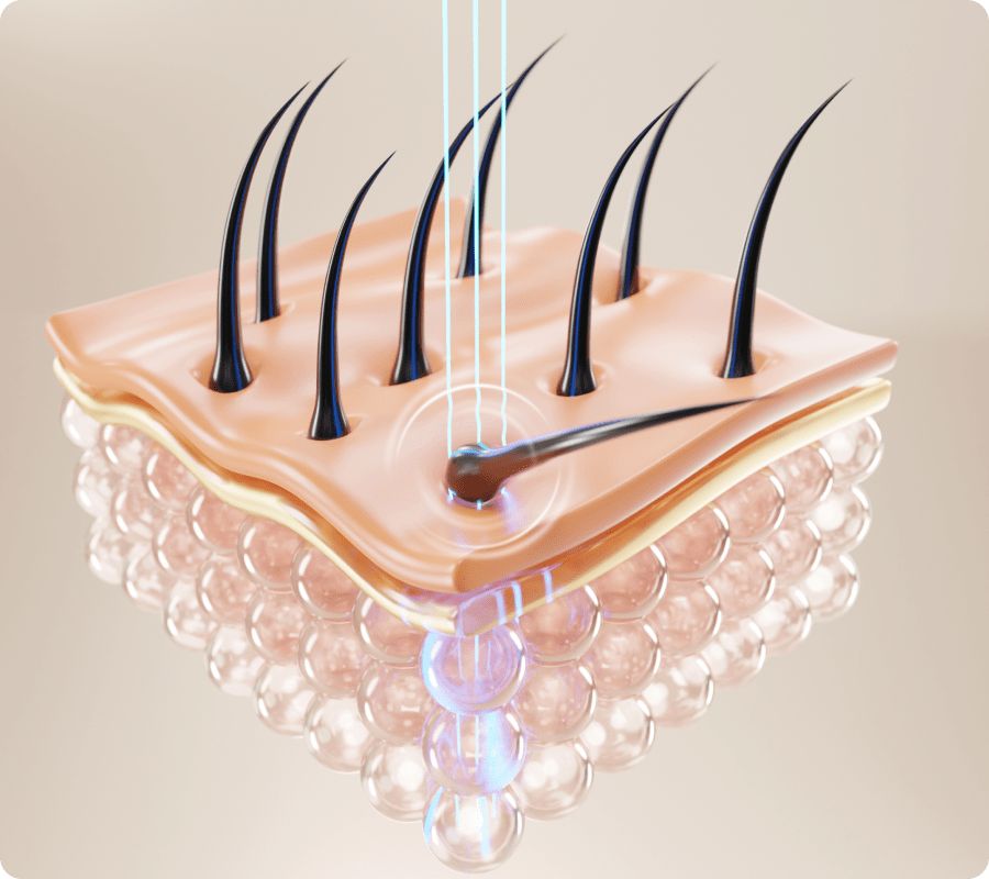 3D illustration of Epilaser 808 laser targeting hair follicles