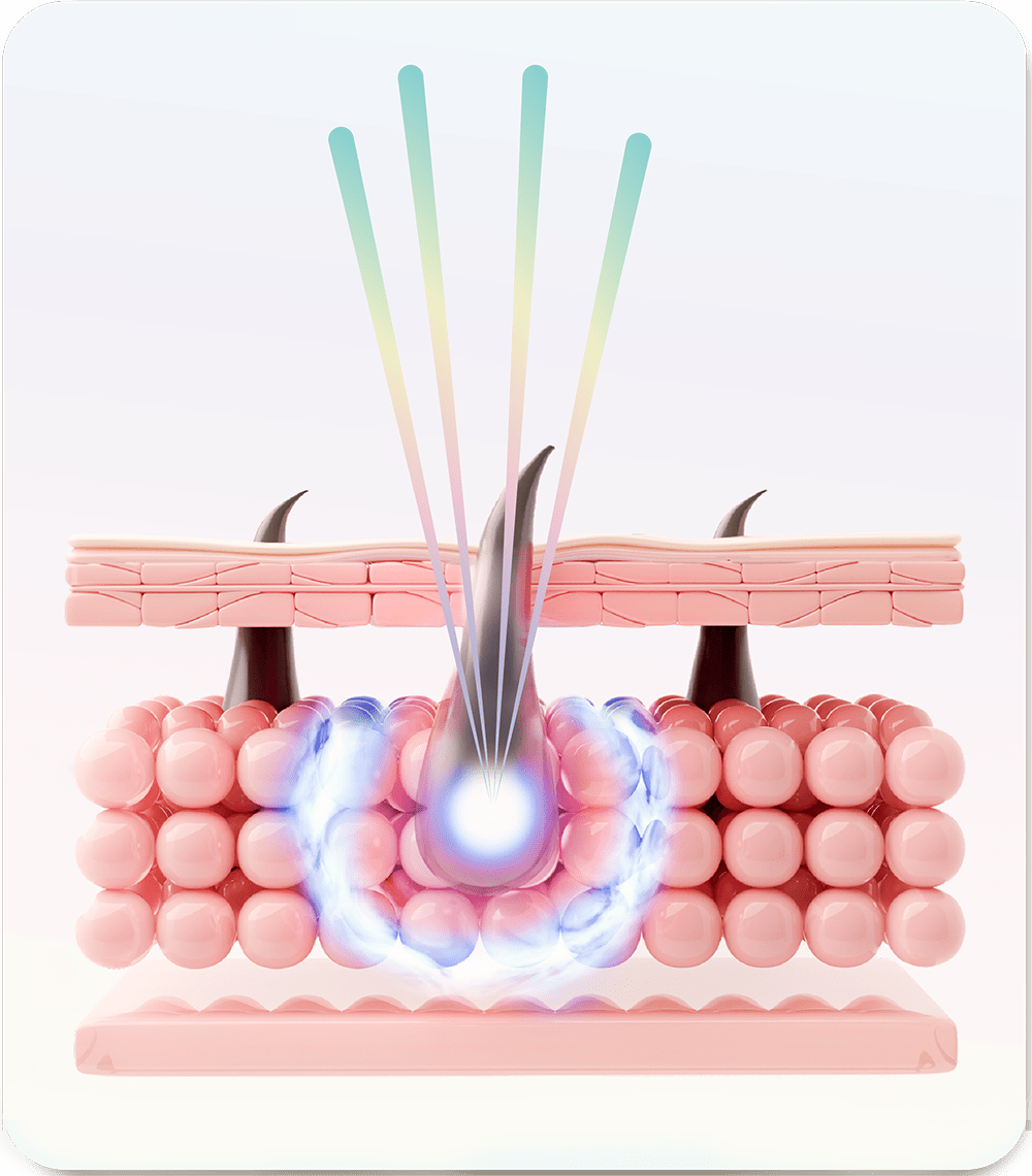 Epilaser precise follicle targeting